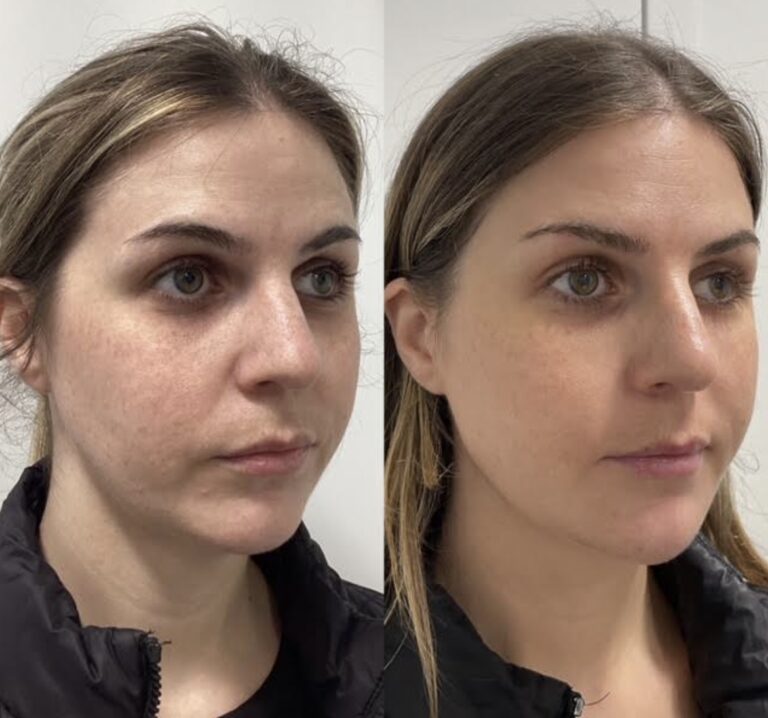 Before and after of a woman from a side profile option 2